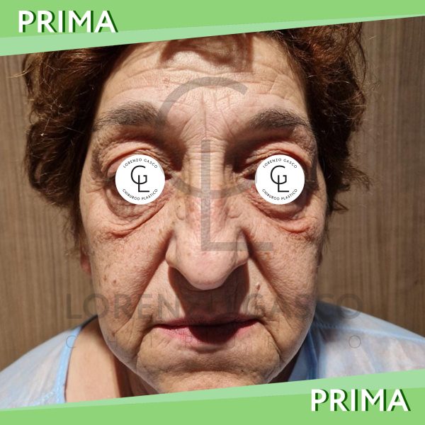 Blefaroplastica - Dr. Lorenzo Gasco blefaroplastica2024-1