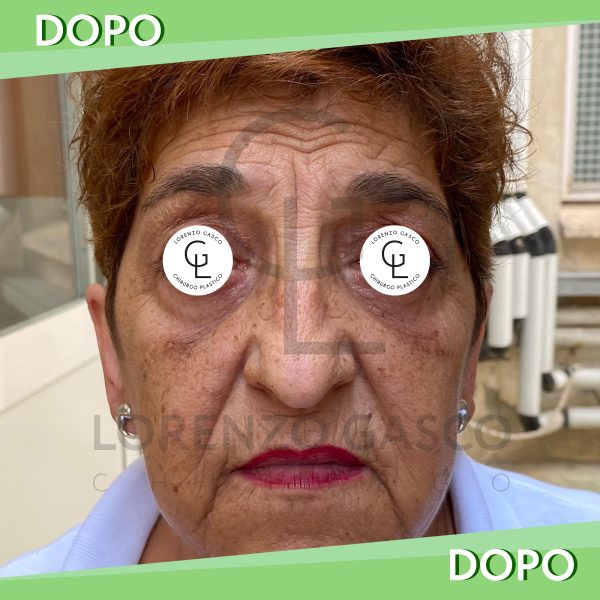 Blefaroplastica - Dr. Lorenzo Gasco blefaroplastica2024-2